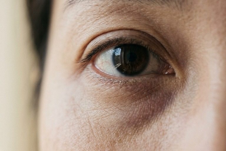 Close-up of the under-eye area showing subtle shadowing and skin texture, used to illustrate that dark circles have more than one cause