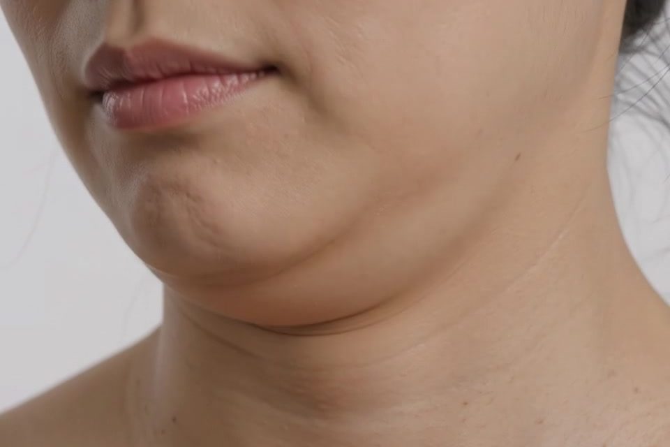 Close-up still from a three-quarter profile video showing submental fullness against a clean white background, illustrating the concern the article addresses