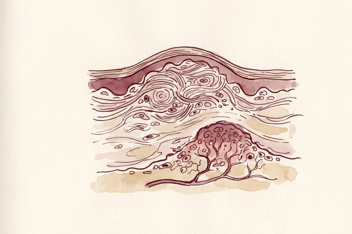 A hand-drawn ink and watercolour anatomical plate of skin in cross-section with a raised dome of dense, swirling scar tissue spreading wider than the small wound beneath it, warm paper, no face, no text; a generated illustration, not a photograph