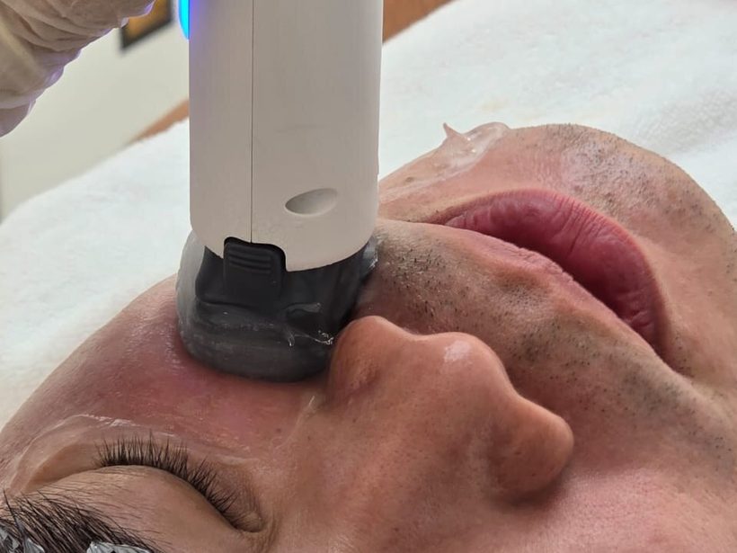 Dr Ong Jin Khang receiving the XERF radiofrequency treatment on his forehead, the white rectangular-tip handpiece visible against his skin
