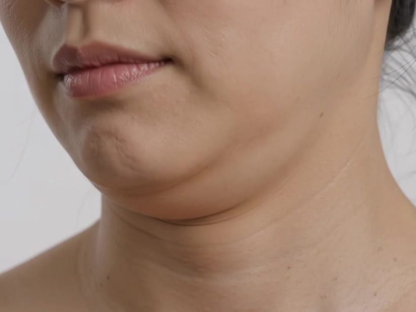 Close-up still from a three-quarter profile video showing submental fullness against a clean white background, illustrating the concern the article addresses