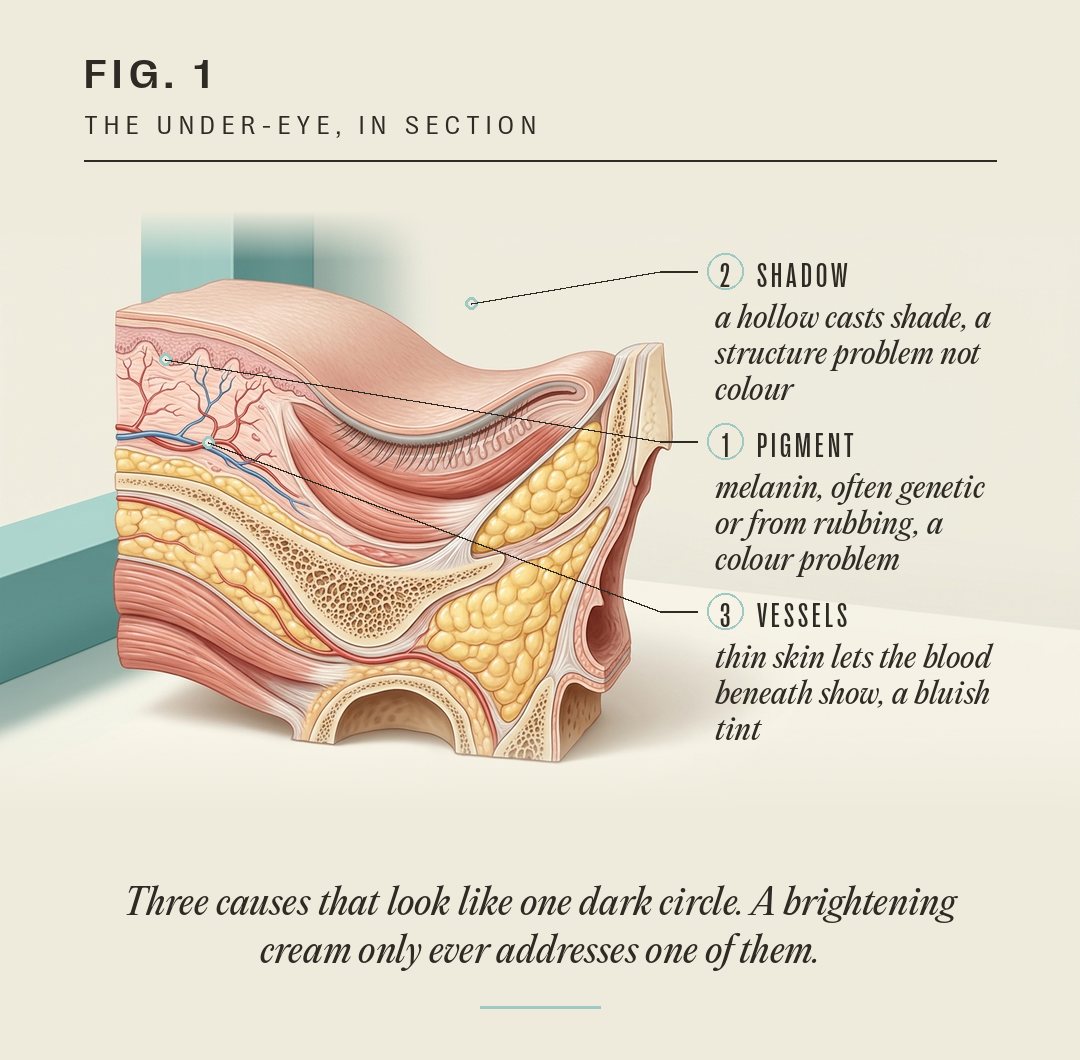 Labelled cross-section of the under-eye. 1, pigment: melanin in the skin, often genetic or from rubbing, a colour problem. 2, shadow: a hollow that casts shade, a structure problem. 3, vessels: thin skin lets the blood beneath show as a bluish tint.