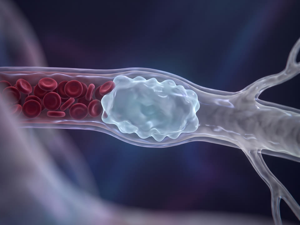 Illustration of a small artery with a clear gel blockage inside it, red blood cells held back on one side and the branches beyond it empty