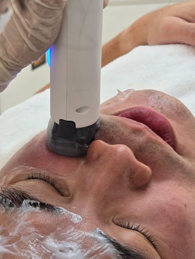 Dr Ong Jin Khang lying in a treatment chair in Hong Kong while the XERF handpiece is applied to his forehead